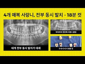 4개 매복 사랑니, 전부 동시 발치 증례 - 18분 컷