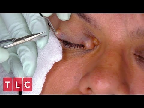 Dr. Lee Removes Hilda's Hidrocystoma | Dr. Pimple Popper