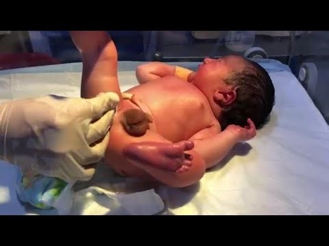 👉 Why This Premature Baby Cries During Cleaning? 👶🧼 #NICU #PrematureBaby