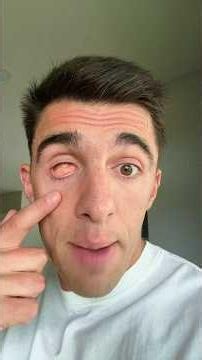 MY REMOVED EYEBALL 😮