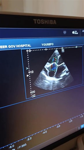 10K views · 63 reactions | Four-chamber dilatation with biventricular...