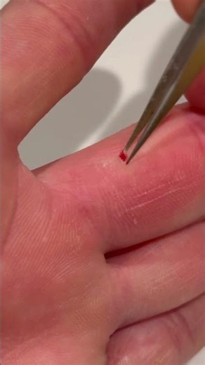 Satisfying wood sliver removal #diy surgery #satisfying #sliver removal #operation