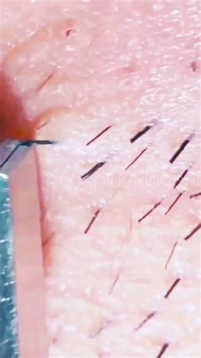 #pimple #tweezer #plucking #blackheads #facialhair #satisfying #beard #hairgrowth