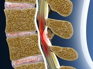 Mild® Procedure (Vertos Medical) | New York Spine & Wellness Center