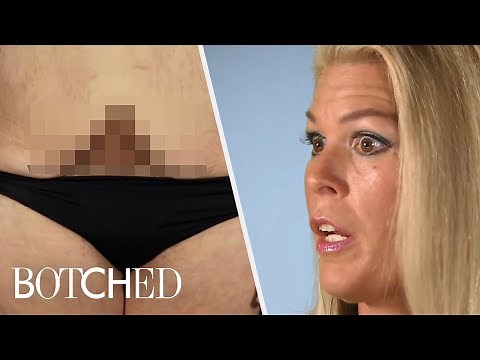 Tummy Tuck Surgeries Gone Wrong | Botched | E!
