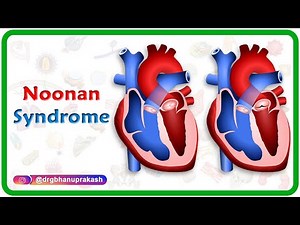 Noonan syndrome - Usmle step 1
