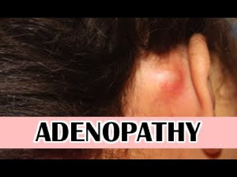 Lumps behind ear, swollen glands (Adenopathy)