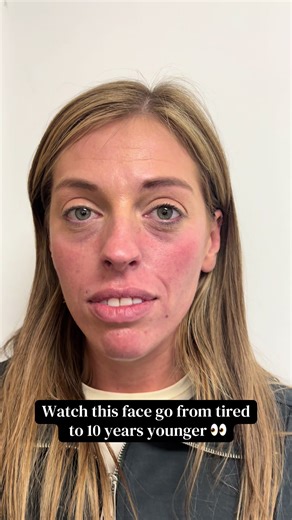 Enhancing your natural beauty, smoothing, lifting, and refreshing- all while keeping it real ✨ Feel like the best version of yourself, effortlessly! #nonsurgical #facelift #natural #glasskin #aestheticvideos