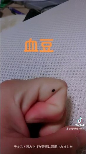 #血豆#治療法 #コメント大歓迎 #直し方