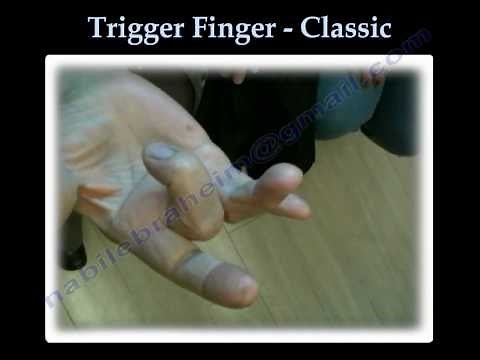 Trigger Finger Classic - Everything You Need To Know - Dr. Nabil Ebraheim