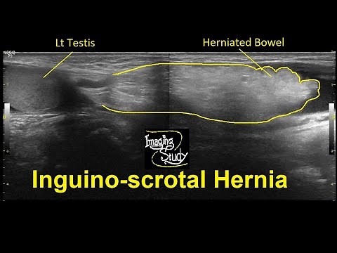 Inguino-scrotal Hernia || Ultrasound || Case 32