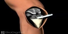 Animation of Knee Replacement Surgery