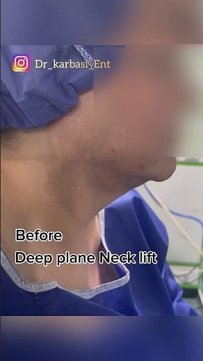 Deep plane Neck Lift before and after transformation | DrK