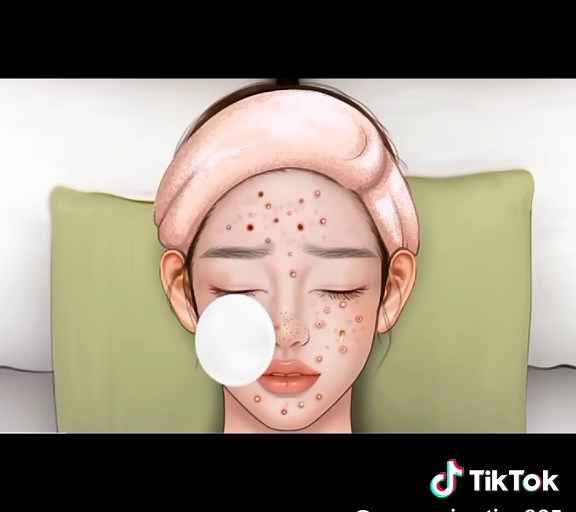 Asmr pimple popping #asmr #pimplepopper #satisfying #animation #treatment