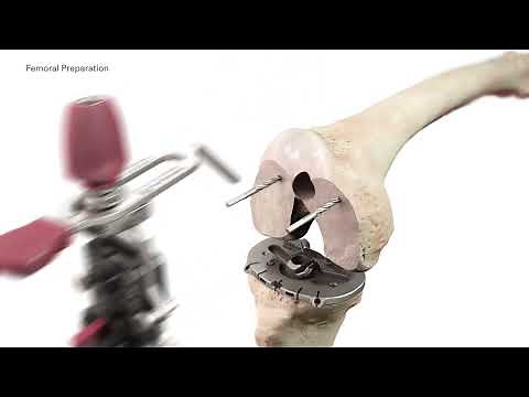 ATTUNE Revision FB Surgical Technique Animation