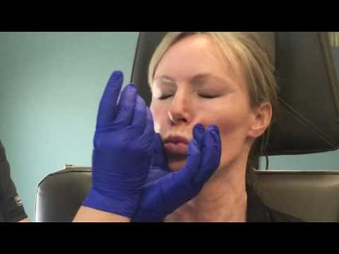 Botox in the neck for a smoother, tighter look