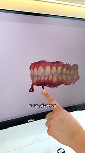 Curious what a 3D dental scanner actually does? Dr Phil from Tailored Teeth Burwood walks us through this innovative piece of technology (called an intra oral scanner) explaining how it works and what it is used for. At Smile On Clinics, we use modern digital technology to support accurate assessments and help guide your dental care in a comfortable and efficient way. 📍 To book an appointment at one of our 40 locations, visit www.smileon.com.au to find a location near you! ---------- Disclaimer