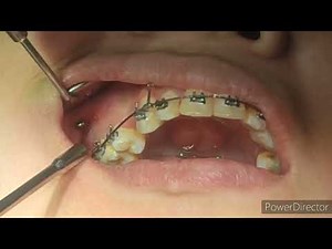 Orthodontic Tads(Temporary anchoring device screw) installation