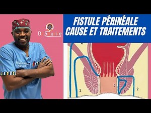 Perianal fistula: Why does it occur? How is it treated? #100smileschallenge by @docteursourire