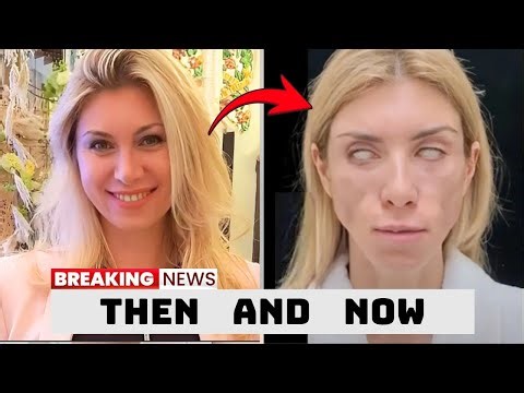 20 Stars DESTROYED by Plastic Surgery! You’d Never Recognize Today