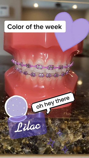 Lilac Braces: Embrace the Trendy Purple Orthodontic Choice