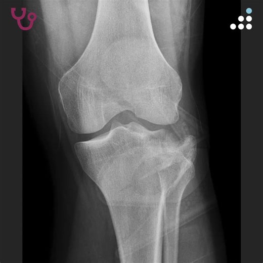 Tibial Plateau Fracture in 35M