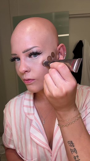 Living with Alopecia Universalis: My Story of Never Growing Hair