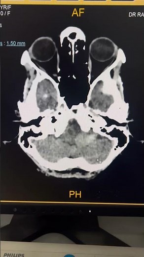 Hemangioblastoma Explained in 40 Seconds! #shorts