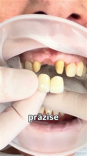 This is how we insert a front tooth bridge.