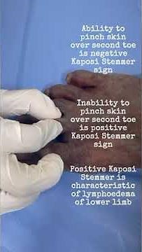 Kaposi Stemmer sign in Lymphedema