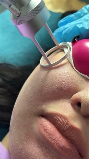 Alpha CO2 fractional laser #skincare #co2laser #satisfying #dubai #duet