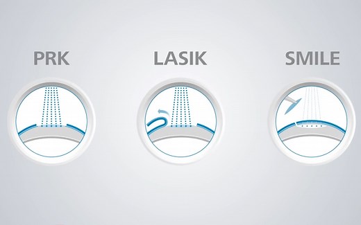 【中英双字】【激光视力矫正手术区别】【表层全激光/半飞秒/全飞秒】LASIK, PRK, SMILE
