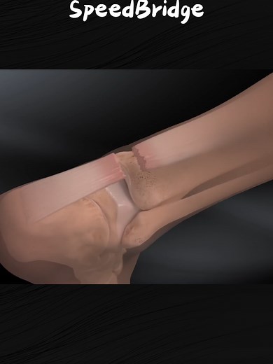Achilles Midsubstance Speed Bridge Procedure! (3D Animation) #achilles #achills #midsubstance #speedbrigde #feet #feetpain #damge #speedbrigde #procedure #watches #3danimation #medicalworld