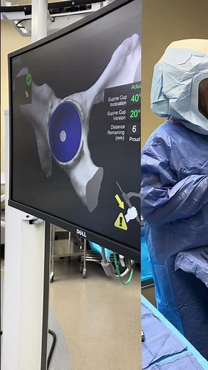 Right Total Hip Replacement 🔥🦿 | MAKO Robotics + Stryker Precision