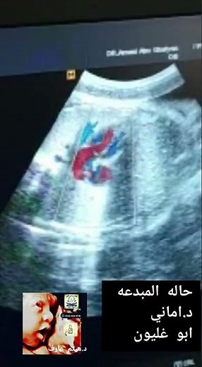 foramen ovale aneurysm fetal ultrasound