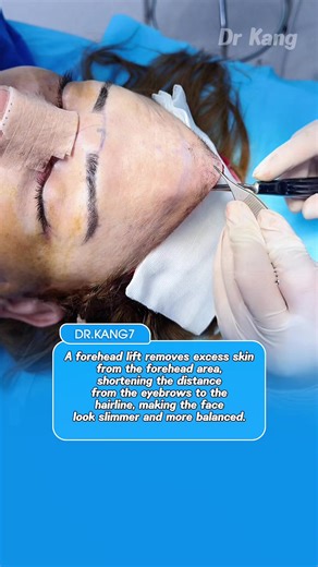 Forehead Lift: Achieve a Balanced and Slimmer Look