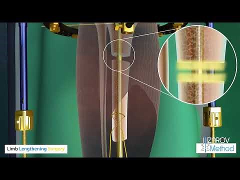 Limb Lengthening Surgery - Ilizarov Method - LiveLifeTaller.Com
