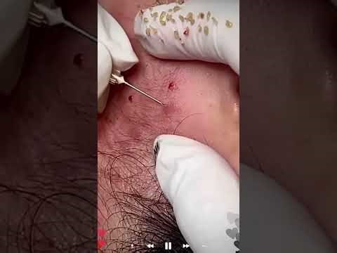 Skincare | Blackheads Removal #726 #tweezers skincare #blackheads blackheads