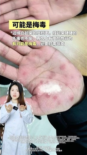 秋冬手上常见的几种皮肤问题，15秒教你正确区分和处理 #角化型湿疹 #手干燥粗糙 #雷诺现象 #抖出健康知识宝藏 #医疗健康创作训练营