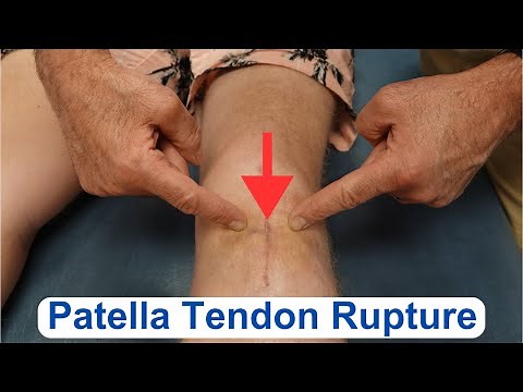 Patella Tendon Rupture Evaluation