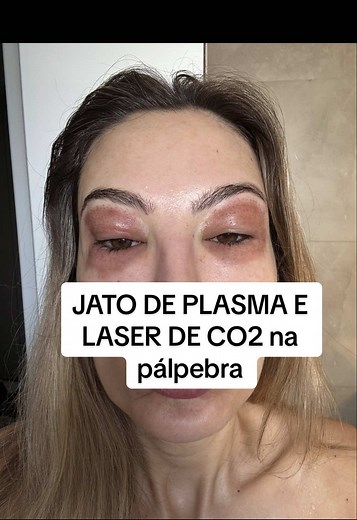 Transformação das Pálpebras: Jato de Plasma e Laser CO2