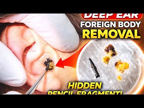 Deep Ear Foreign Body Removal In Young Girl / Hidden Pencil Fragment & Wax Cleared Safely.