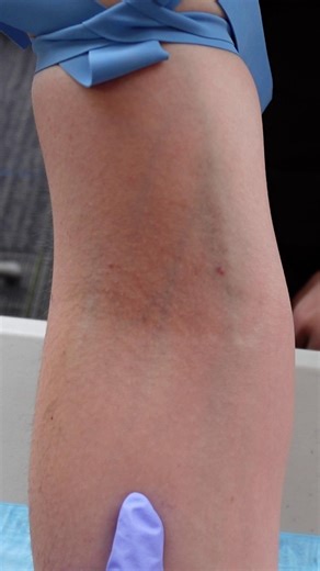 Quick tip to remember veins in the antecubital fossa Basilic is close to the Body Median Cubital is in the Middle Cephalic is on the Coast Follow us for more medical tips! | Intelvio Phlebotomy Training Specialists