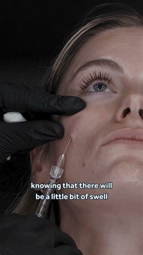 Tear Trough Filler Techniques for Avoiding Overfilling 💎 Global Evidence Matrix Advice for Injectors