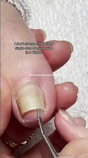 Do you have a toenail that is lifted from the nail bed? I can show you how to start the process to