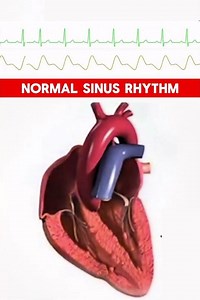 Ventricular Tachycardia to Normal Sinus Rhythm | #shorts #cardiology #ecg #hearthealth