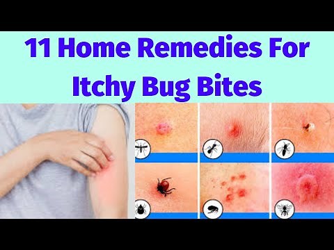 11 Home Remedies For Itchy Bug Bites