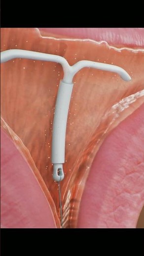 How Do IUDs (Intrauterine Devices) Work? | Birth Control #4k #animation #asmr