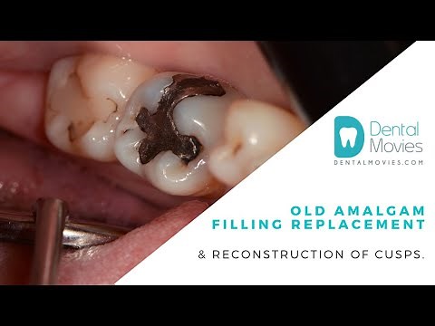 Old amalgam filling replacement & reconstruction of cusps. 🦷