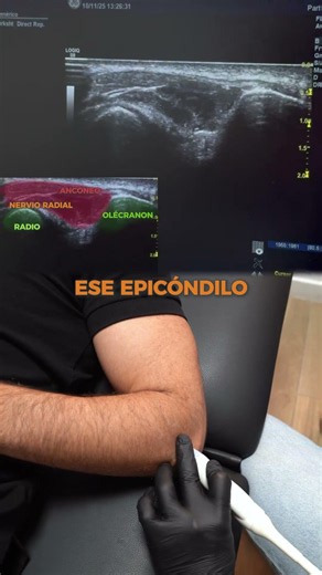 Neuromodulación ecoguiada rama nerviosa radial